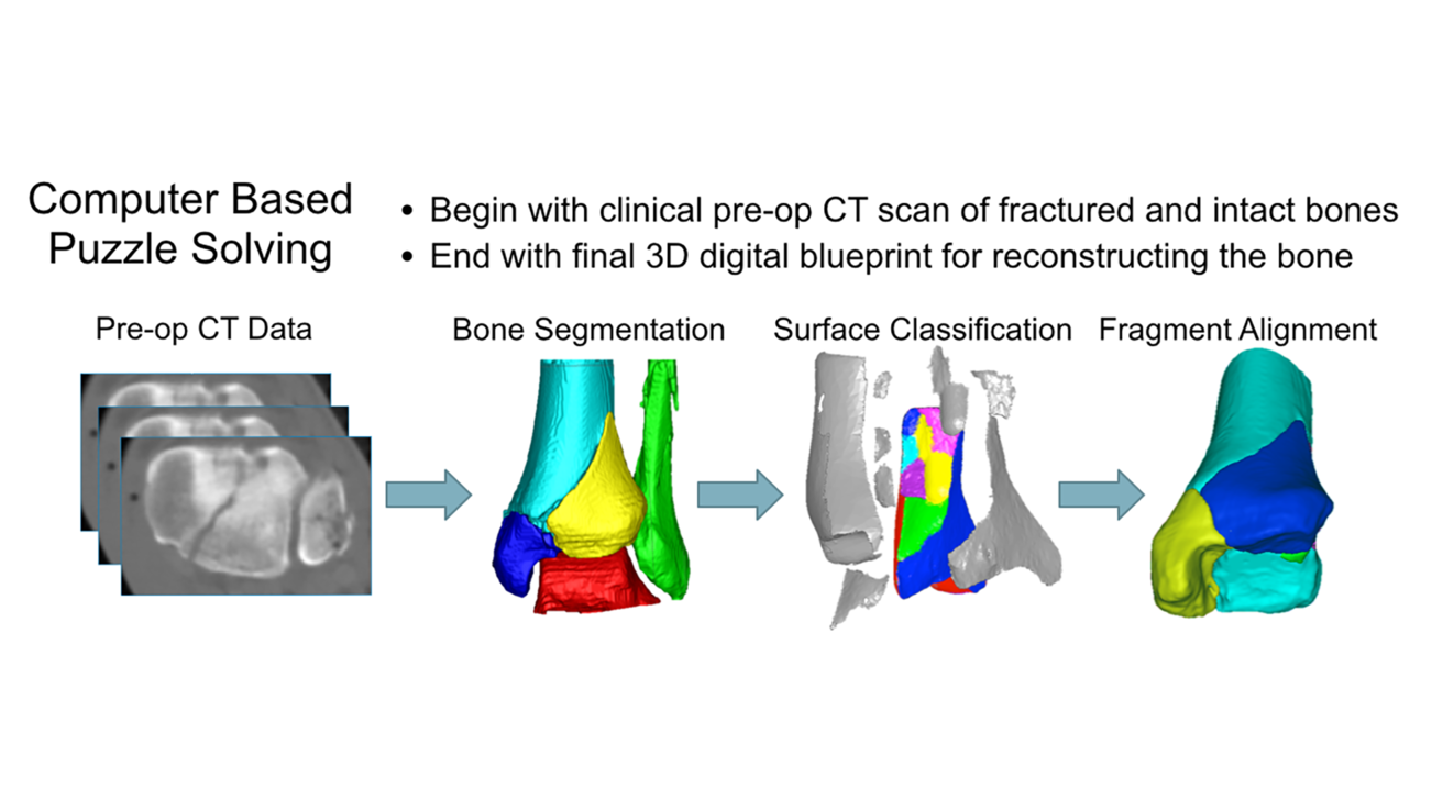 3D Puzzle Solving for Pre-Operative Fracture Reduction Planning